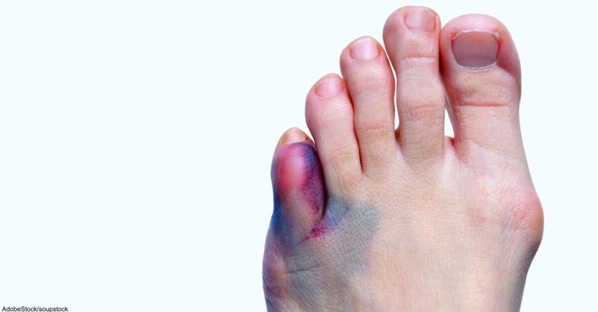 Why Are My Feet Purple? - The Diabetes Site News
