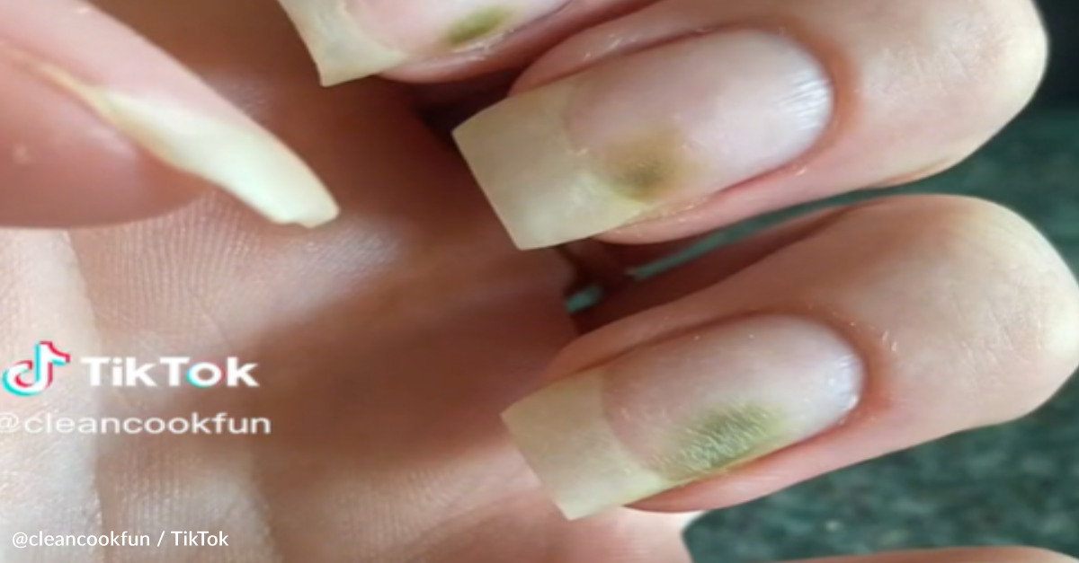 Woman Shows Off Fungus Nails After Beautiful Manicure Gone Wrong
